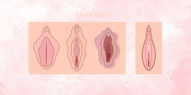 Labia Reduction Surgery (Labiaplasty) by Dr. Amulya Gumpalli in Madhapur, Hyderabad – Expert Cosmetic Gynecology Care